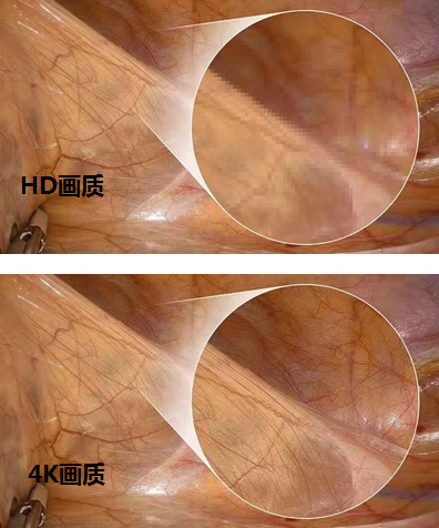 腹腔镜都有什么品牌厚积薄发 ｜ 鹰利视原研4K腹腔镜摄像系统比肩进口产品！_https://www.jmylbn.com_新闻资讯_第3张