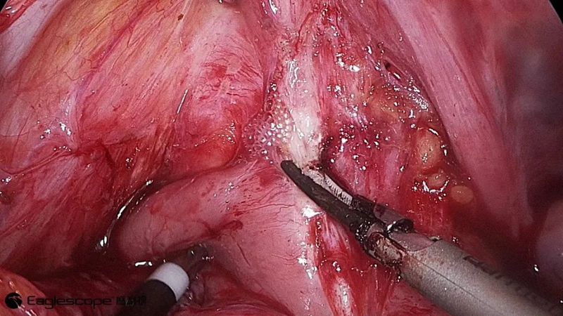腹腔镜都有什么品牌厚积薄发 ｜ 鹰利视原研4K腹腔镜摄像系统比肩进口产品！_https://www.jmylbn.com_新闻资讯_第4张