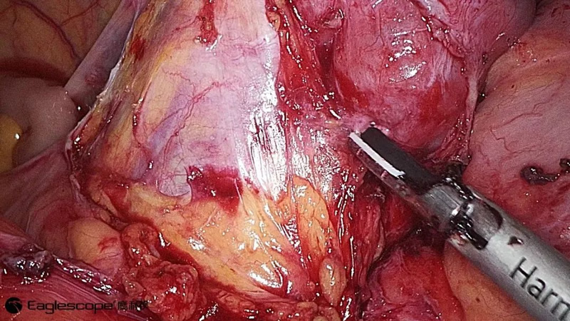 腹腔镜都有什么品牌厚积薄发 ｜ 鹰利视原研4K腹腔镜摄像系统比肩进口产品！_https://www.jmylbn.com_新闻资讯_第5张