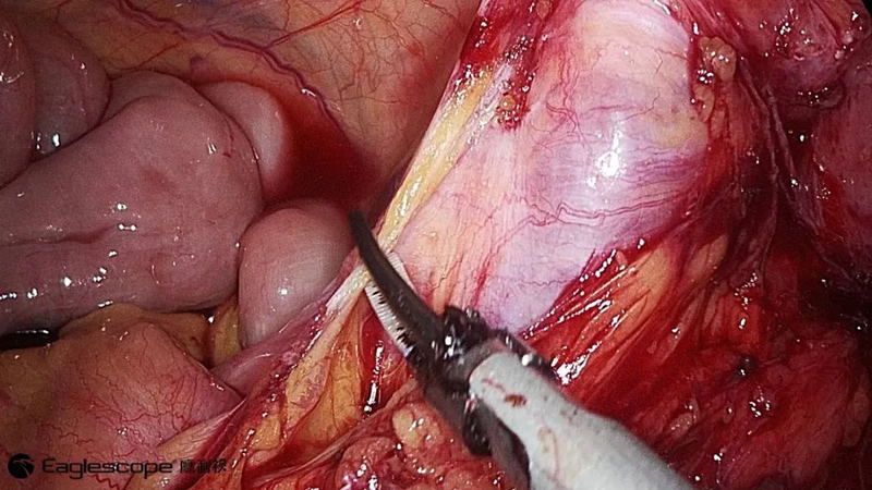 腹腔镜都有什么品牌厚积薄发 ｜ 鹰利视原研4K腹腔镜摄像系统比肩进口产品！_https://www.jmylbn.com_新闻资讯_第6张