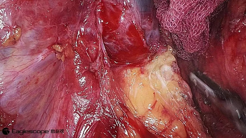 腹腔镜都有什么品牌厚积薄发 ｜ 鹰利视原研4K腹腔镜摄像系统比肩进口产品！_https://www.jmylbn.com_新闻资讯_第7张