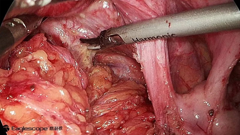 腹腔镜都有什么品牌厚积薄发 ｜ 鹰利视原研4K腹腔镜摄像系统比肩进口产品！_https://www.jmylbn.com_新闻资讯_第8张