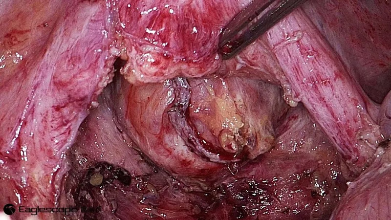 腹腔镜都有什么品牌厚积薄发 ｜ 鹰利视原研4K腹腔镜摄像系统比肩进口产品！_https://www.jmylbn.com_新闻资讯_第9张