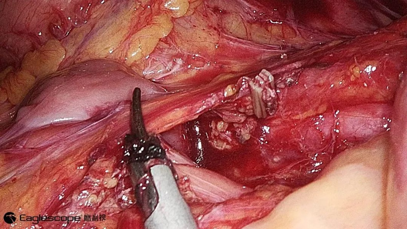 腹腔镜都有什么品牌厚积薄发 ｜ 鹰利视原研4K腹腔镜摄像系统比肩进口产品！_https://www.jmylbn.com_新闻资讯_第10张