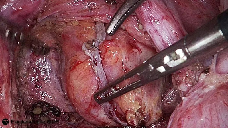 腹腔镜都有什么品牌厚积薄发 ｜ 鹰利视原研4K腹腔镜摄像系统比肩进口产品！_https://www.jmylbn.com_新闻资讯_第11张